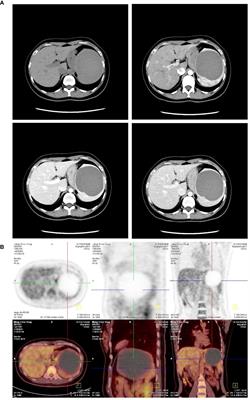 Abrupt elevation of tumor marker levels in a huge splenic epidermoid cyst, a case report